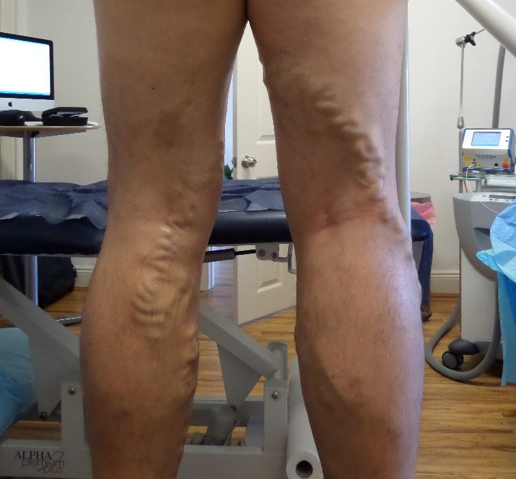 mans legs with veins
