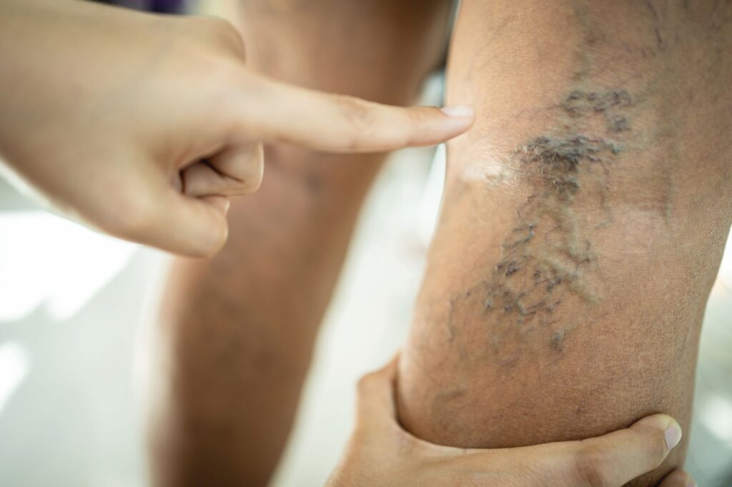 Surgery-free treatment for varicose veins