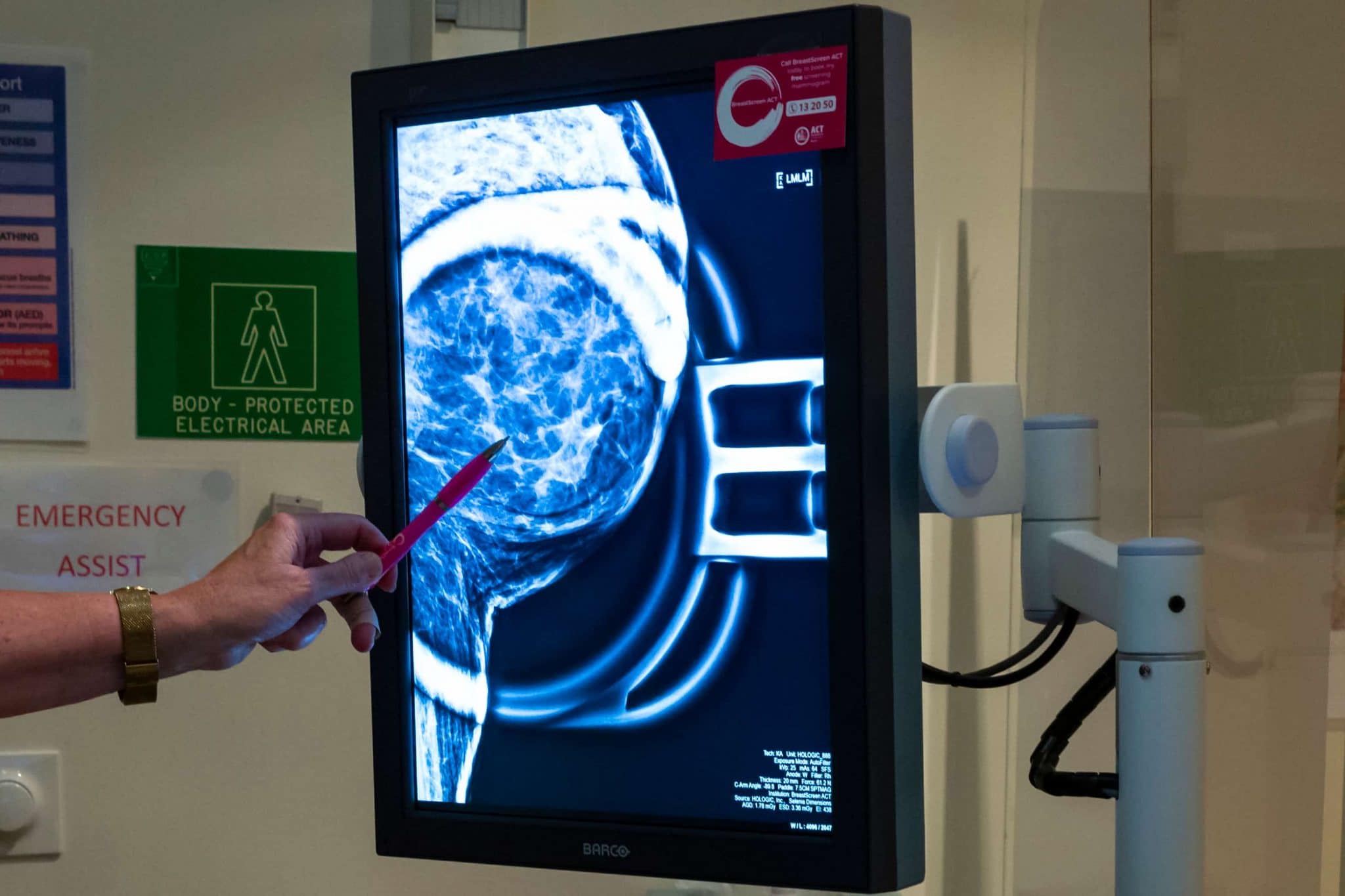 COVID 19 Closes BreastScreen Services In ACT NSW Canberra Daily   BreastScreen ACT Screening Of A Breast With Cancer Detected In The Scan Highlighting The Benefit Of Getting Screened Because The Machine Can Detect Tiny Specs Of Cancer Kerrie Brewer 1180 Scaled 