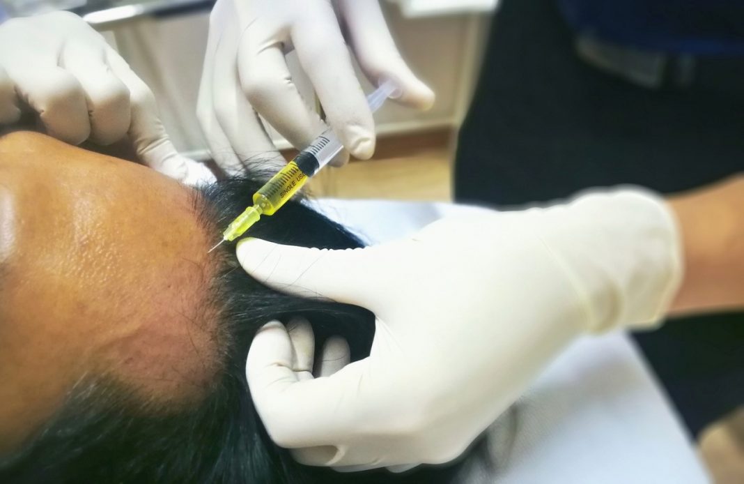 Man having hair loss treatment on his forehead hairline